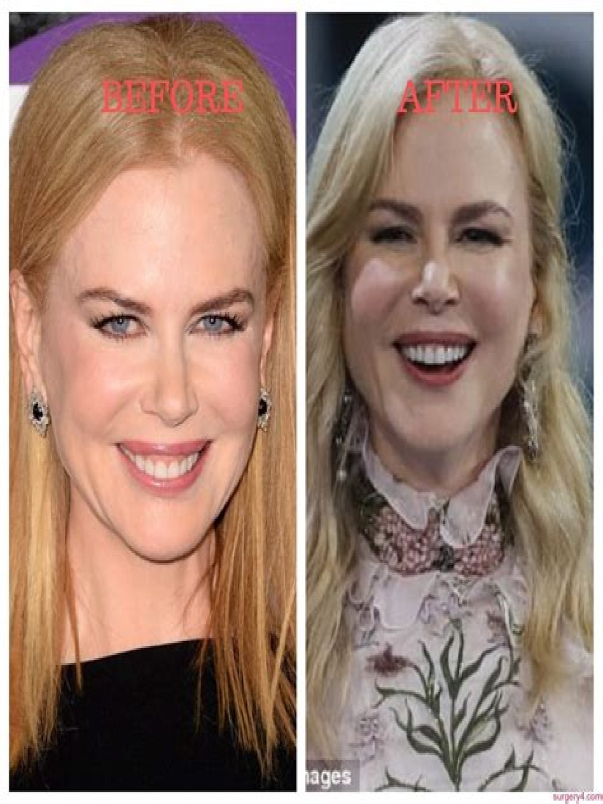Nicole Kidman's "Lioness" Plastic Surgery: Uncovering Hidden Truths