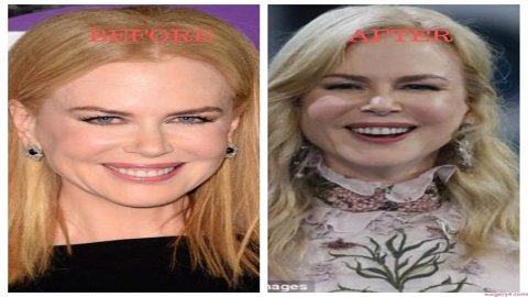 Nicole Kidman's "Lioness" Plastic Surgery: Uncovering Hidden Truths